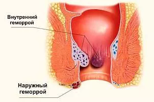 Иссечение анальной трещины